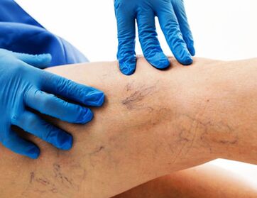 Varicose veins in legs