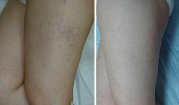 Veins before and after using the gel